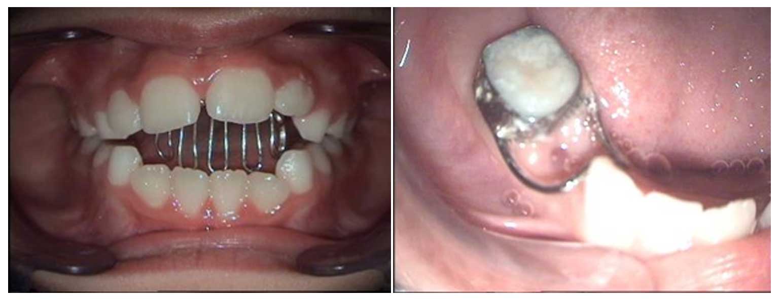 Orthodontic Treatment means Braces