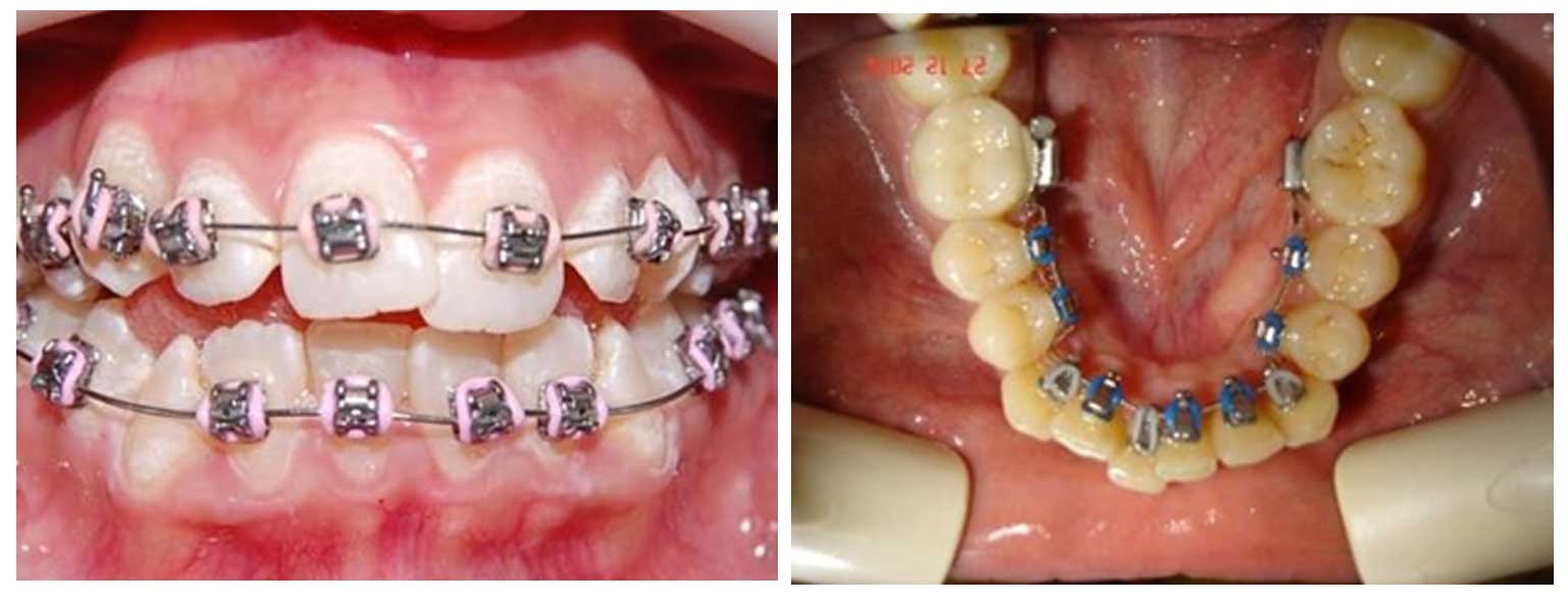 Aesthetic Oriented Orthodontics 