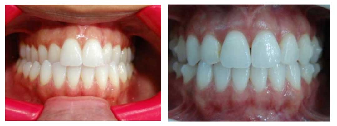 Why INVISALIGN?