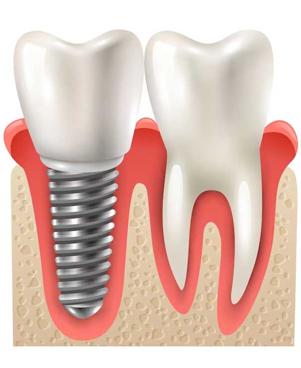Same Day Dental Implants Clinic 