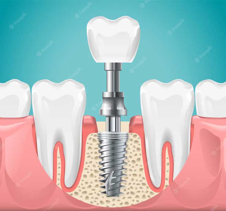 Why Shine & Smile Dental Clinic?