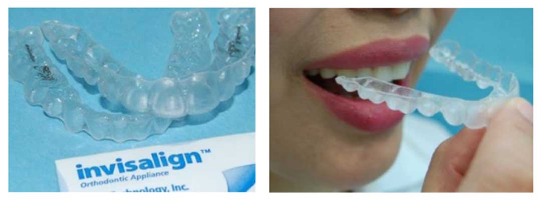 Invisalign Orthodontic Treatment