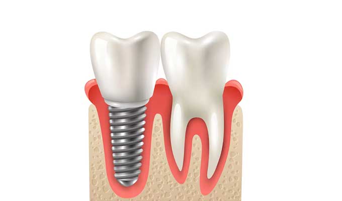 
Dental Implants